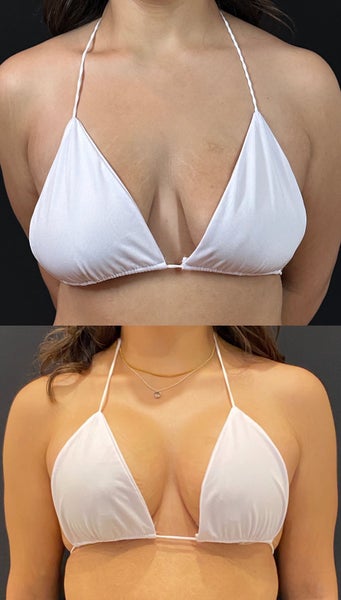 PODCAST: East vs. West: Comparing Breast Surgery Size Trends with Dr. Anna  Steve PODCAST: East vs. West: Comparing Breast Surgery Size Trends with Dr.  Anna Steve
