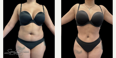 26 year old female treated with VASER Liposuction, Renuvion J Plasma Skin Tightening and post-operative lymphatic massages - 26 year old female who underwent VASER assisted liposculpting and Renuvion J plasma skin tightening of the abdomen, flanks, axilla, upper/middle/lower back; fat grafting to the buttocks and lateral hips (Brazilian Buttock Lift, BBL). Patient underwent 6 post-operative lymphatic massages.