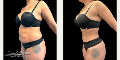 26 year old female treated with VASER Liposuction, Renuvion J Plasma Skin Tightening and post-operative lymphatic massages - 26 year old female who underwent VASER assisted liposculpting and Renuvion J plasma skin tightening of the abdomen, flanks, axilla, upper/middle/lower back; fat grafting to the buttocks and lateral hips (Brazilian Buttock Lift, BBL). Patient underwent 6 post-operative lymphatic massages.