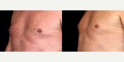 70 year old man treated with Nipple reduction - 70 year old man treated with Nipple reduction Photos depict before and 6 months after surgery