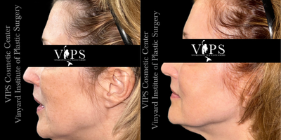 55-64 year old woman treated with Skin Lightening, Skin Rejuvenation, IPL - 55-64 year old patient treated with a series of (3) Elluminate Advanced Photofacial with IPL treatments for hyperpigmentation on the face, age spots and sun damage. The result is more even skin tone, a reduction in visible hyperpigmentation and and overall brightness to her skin's appearance
