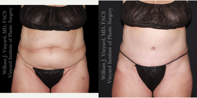 55-64 year old woman treated with Diastasis Recti Repair, Mommy Makeover, Tummy Tuck - 65+ year old patient an Extended Abdominoplasty (tummy tuck) with Rectus Muscle Plication (muscle repair), Umbilicoplasty (belly button creation), and Mons Pubis lift (pubic lift) to to address abdominal skin laxity, diastasis recti (muscle separation) and body contouring. The result was a flatter abdomen, and patient reports she has more energy and confidence than she has in years.