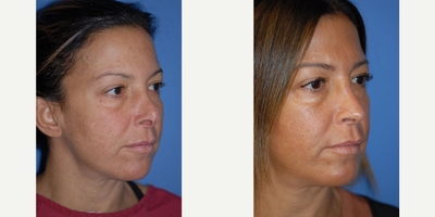 Rhinoplasty - Rhinoplasty