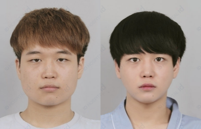 18-24 year old woman treated with V Line Surgery - Square Jaw Surgery + Male Facial Contouring