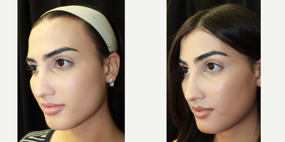 25-34 year old woman treated with Facial Feminization Surgery - FFS Surgery