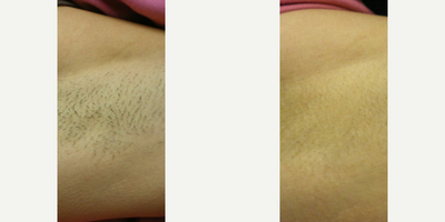 Patient treated with Laser Hair Removal - Patient treated with Laser Hair Removal