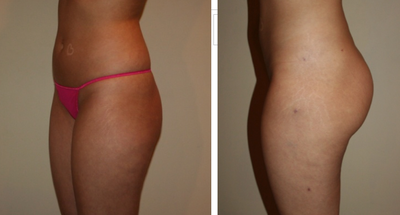 Brazilian Butt Lift - 