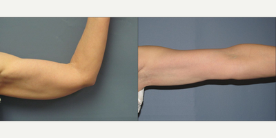 45-54 year old woman treated with Bicep Implants - This 50-year-old woman underwent fat transfer to the arm.