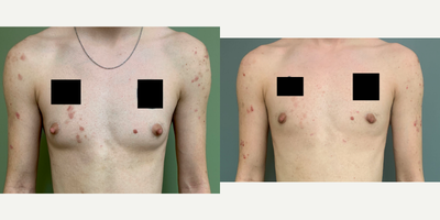 18-24 year old man treated with FTM Chest Masculinization Surgery - This patient was treated with a keyhole incision mastectomy, liposuction of the chest and nipple reduction.
