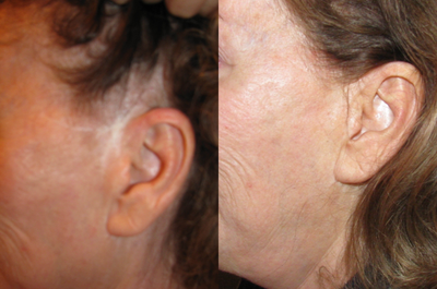 65-74 year old woman treated with Permanent Makeup - 65 year old out post facelift patient (from a separate practice) was left with unusual scarring around ears. Cosmetic tattooing broke up the look of the scars and camouflaged them within the surrounding skin.