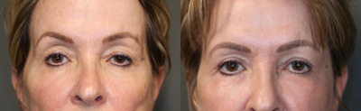 Brow and Upper Eyelid Evening - Filler to temples, surgery to brows and lids, laser to face.