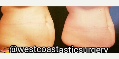 Woman treated with UltraShape Power - Woman treated with UltraShape Power