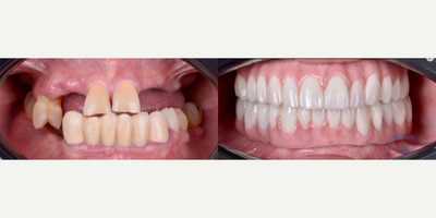 Person treated with Dental Bridge, Dental Implants - All on 6 Upper and BottomZirconia Overdenture