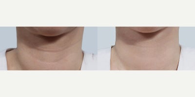 35-44 year old woman treated with Dermal Fillers, Ultherapy, Thermage FLX  (Neck Wrinkle Care) - 35-44 year old woman treated with Dermal Fillers, Ultherapy, Thermage FLX (Neck Wrinkle Care)