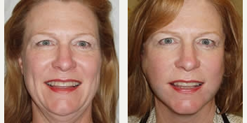 Thread Lift - Woman treated with Thread Lift