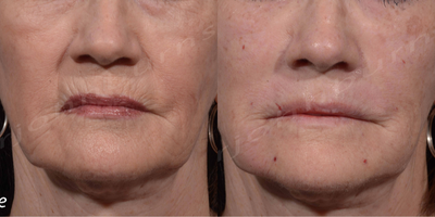 65-74 year old woman treated with Liquid Facelift - Perioral rejuvenation as part of a Liquid Facelift. 2 syringes Volbella to upper and lower lip lines.