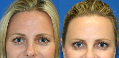 Botox for Crow's Feet - 	Eyes