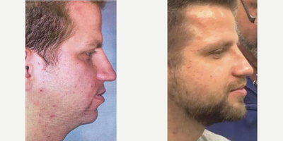 35-44 year old man treated with Chin Liposuction - Two months after my trademarked procedure 'The Angle, and a non-surgical chin augmentation with Voluma.