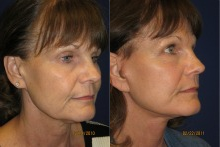 Female patient treated for jowls and neck laxity - 
	Patient had facial-firming, and neck-firming procedures, along with Laser skin treatment
