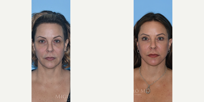 47 year old woman treated with Neck Lift - 47 year old woman treated with Facelift with submandibular gland reduction, Neck Lift, and muscle sling to create a youthful neckline and contour.