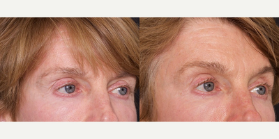 Woman treated with Bellafill - Woman treated with Bellafill