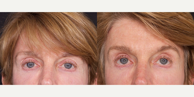 Woman treated with Bellafill - Woman treated with Bellafill
