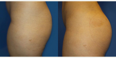 Woman treated with Brazilian Butt Lift, Liposuction, Butt Lift, Butt Augmentation - Name: Brazilian Butt Lift (BBL)Purpose: Purpose: While the goal of a standard butt lift is generally to eliminate loose skin and decrease size, a BBL fills in sunken areas to create pleasing additional volume. The procedure can provide dramatic, transformative results for patients who long for a more youthful, perky, or voluptuous backside. It can also improve asymmetry and similar cosmetic flaws.How it works: A Brazilian butt lift (BBL) is a unique procedure, different from more traditional forms of buttocks augmentation. This innovative technique provides beautiful, natural-looking results without using silicone implants or any type of foreign substance.Results: Total recovery time varies with the individual and the extent of your unique procedure. To maintain your results, it is recommended that you keep a stable weight, since weight gain or loss will naturally change the size of transplanted fat cells.