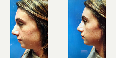 Woman treated with Nonsurgical Nose Job - Liquid rhinoplasty and chin augmentation. 5 minutes to a new look. No downtime. No pain. Lasts 1 year.