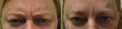 45 Year Old Female Treated For Glabellar Lines - Two weeks after Botox injections into the eyebrow furrows ('11' lines).