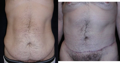 Male tummy Tuck - 
	56-year-old male with abdominal skin laxity and excess fat following weight loss. He underwent abdominoplasty, and he's shown 4 months post-operatively.

