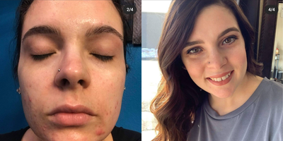 25-34 year old woman treated with Spironolactone For Acne - A woman in her 20s with years of cystic hormonal acne and scarring treated with topical cleocin, oral spironolactone and oral contraceptives