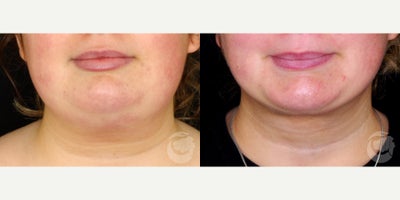 20 year old woman treated with PrecisionTx - 20 year old woman treated with PrecisionTx. Photos depict before and 3 months after surgery.