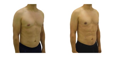 35-44 year old man treated with Abdominal Etching - This patient had little fat deposits and he wanted to define his abs, so an abdominal etching was performed, is a procedure that involves defining abdominal muscles that have been unable to mark despite frequent exercise.