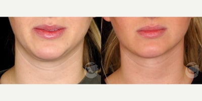 30 year old woman treated with PrecisionTx - 30 year old woman treated with PrecisionTx.Photos depict before and 1 month after surgery.