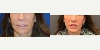 45-54 year old woman treated with Lip Lift - Before and after: Bullhorn Lip Lift performed by Dr. Almonte