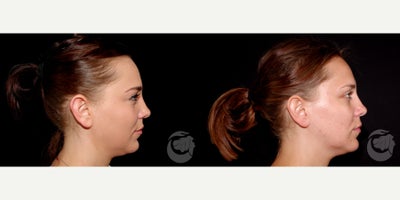27 year old woman treated with CoolMini to the chin. - 27 year old woman treated with CoolMini to the chin. Photos depict before and 2 months after treatment.