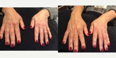 45-54 year old woman treated with Hand Rejuvenation - Dermal Filler is used to rejuvenate the backs of the hands. A microcannula technique is used to maximize comfort and minimize trauma/bruising. Pictured are before and immediately after the procedure.