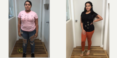 18-24 year old woman treated with Orbera Gastric Balloon - Weight prior to procedure: 181 lbs. 3-month follow-up weight: 156.2 lbs. In three months she lost 24.8 pounds. It is excellent result. She is happy with her progress.