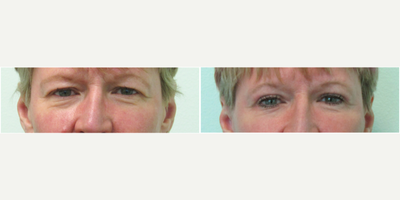 55-64 year old woman treated with Upper Eyelid Surgery under local anesthesia - This woman presented to our Center with the concerns of excessively heavy upper eyelids.  She stated that the physical weight was bothersome to her and that she both looked and felt tired.  She stated that she did not usually wear a lot of eye makeup and wanted a treatment that would naturally open her eyes.  We decided in consultation to perform an upper eyelid lift (blepharoplasty) under local anesthesia in our office using mild sedation with valium.  Procedure time was under an hour and stitches were removed on the 6th day.  She was able to return to full activity 1 1/2 weeks after her procedure.  Her results demonstrate unveiling of her upper lids along with correction of her pre-existing uneven lids (ie her left eye was significantly heavier/droopier pre-procedure).