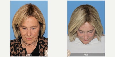 68 year old woman treated with Deep Plane Facelift, Neck Lift, Brow Lift, CO2 Laser, MACS Facelift - 68 year old woman treated with Deep Plane Face and Neck Lift, Temporal Brow Lift, CO2 Laser of Face, MAC