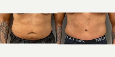55-64 year old man treated with Male Tummy Tuck - 59 yo male s/p abdominoplasty performed under general anesthesia in our on site AAAA certified operating room suite.