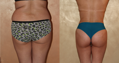 25-34 year old woman treated with Brazilian Butt Lift - Patient desired better contours with enhanced gluteal projection and volume.