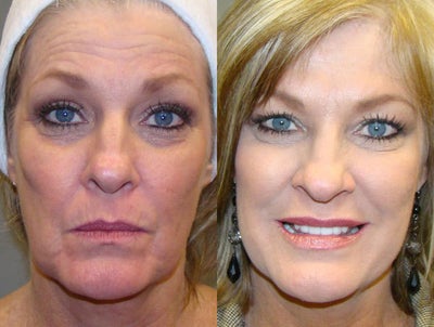 Liquid Facelift with Botox and Restylane - This 52 -year-old woman was treated with Botox on her forehead and crows' feet, and the filler Restylane in her nasolabial folds and lips.