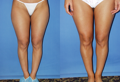 Calf Implants - Before and after medial calf implants. A conservative result just enough to remove that flat look on the inside of the lower leg, producing shape and proportion.