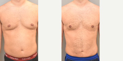 37 year old man treated with Tumescent Liposuction - SAFE Liposuction chest and abdomen