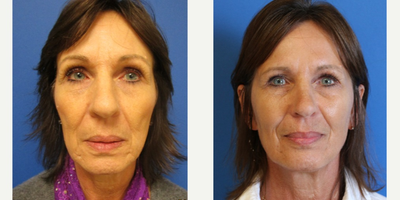 Sculptra - 2 treatments of sculptra, notice natural, improved contour and facial shape