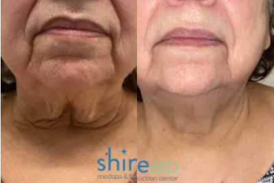 55-64 year old woman treated with Skintyte - PDO Thread Face Lift with 3 Sessions of SkinTyte for Face and Neck area!