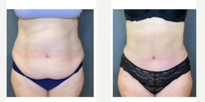 45-54 year old woman treated with Tummy Tuck, Liposuction, Liposculpture, Diastasis Recti Repair - 53 Year old mother of three over one year after full abdominoplasty, rectus muscle separation repair and liposuction of the flanks. She now loves her cute natural belly button and fit, snatched waist!Ht- 5'8.   Wt-180lbs  >> now 172lbs.