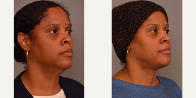 Woman treated with Neck Lift - Woman treated with Neck Lift. Patient had Chin Liposuction and Kybella before but wasn't happy with her results.