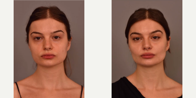 Woman treated with Buccal Fat Removal - Woman treated with Buccal Fat Removal to achieve definition in her mid face
